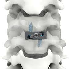 global Cervical Interbody Fusion Cages market